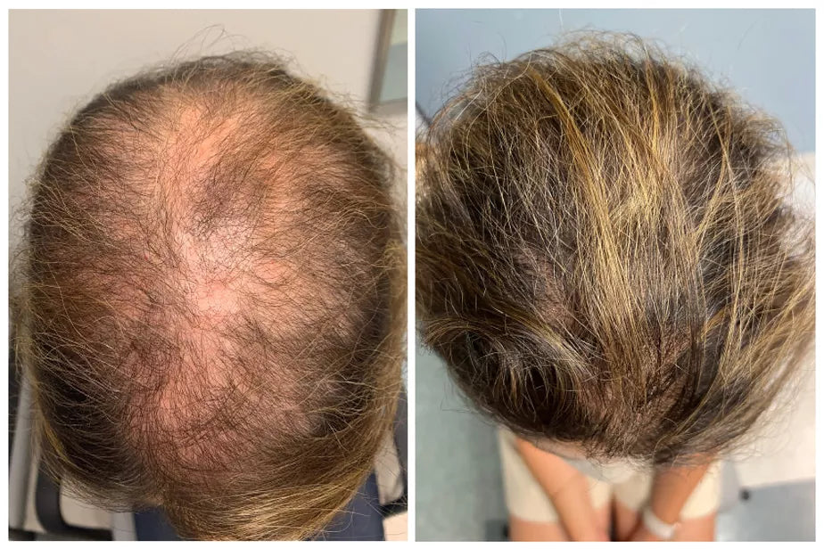 ®FolixDerm Bloquea el DHT y reactiva el crecimiento del cabello Dama