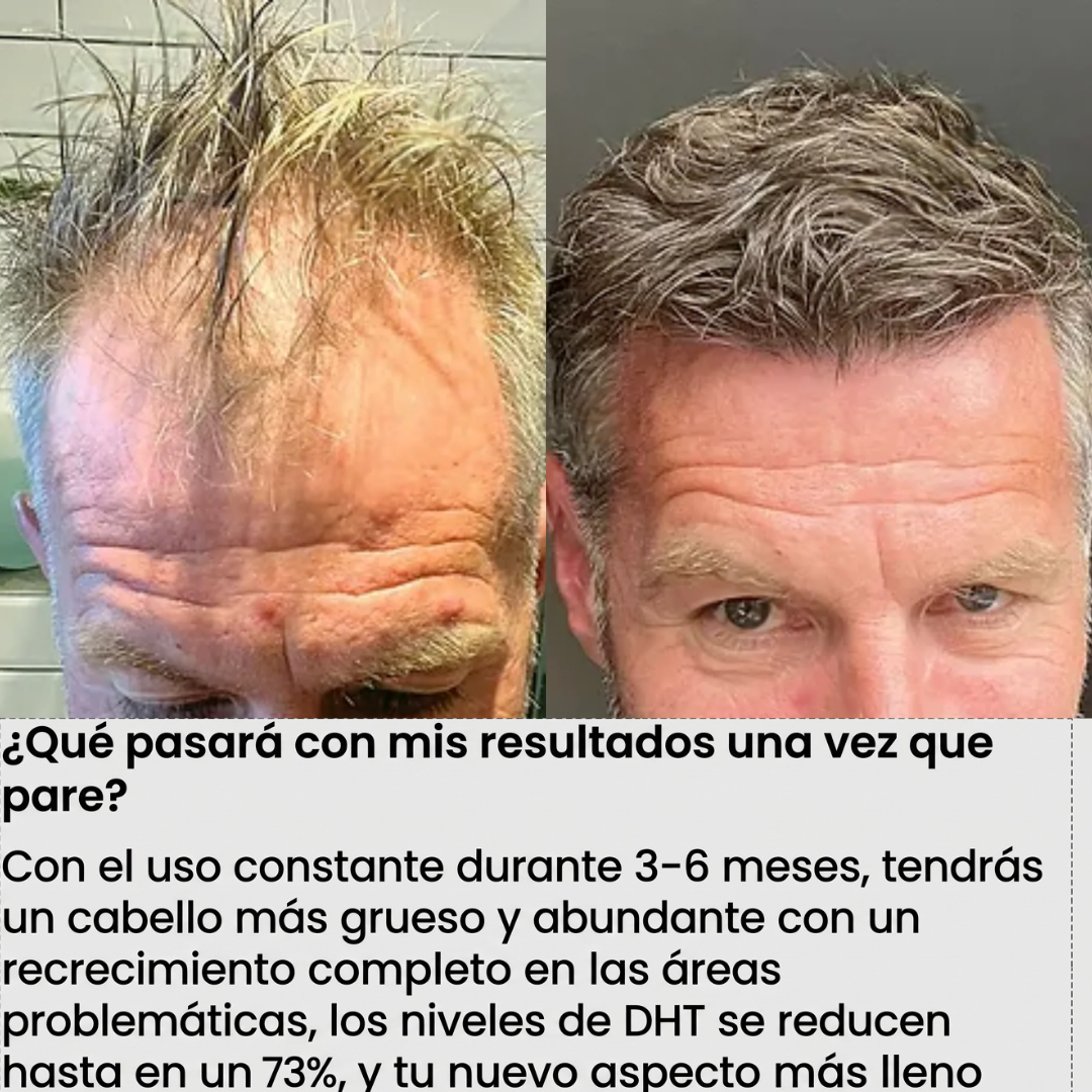 FolixDerm Bloquea el DHT y reactiva el crecimiento del cabello