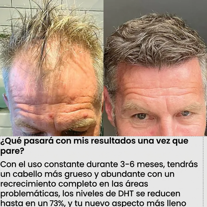 FolixDerm Bloquea el DHT y reactiva el crecimiento del cabello